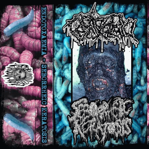 Seborrheic Keratosis : Seborrheic Keratosis - Endotoxaemia